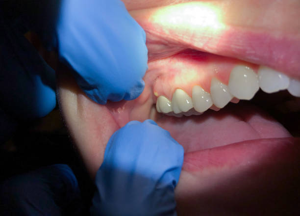 Best Lost Filling or Crown Replacement in Washington, NJ