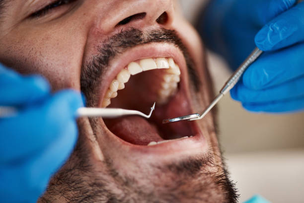 Best Emergency Wisdom Tooth Extraction in Washington, NJ